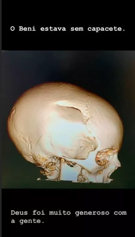 Tomografia do crânio do filho de Luciano Huck e Angélica