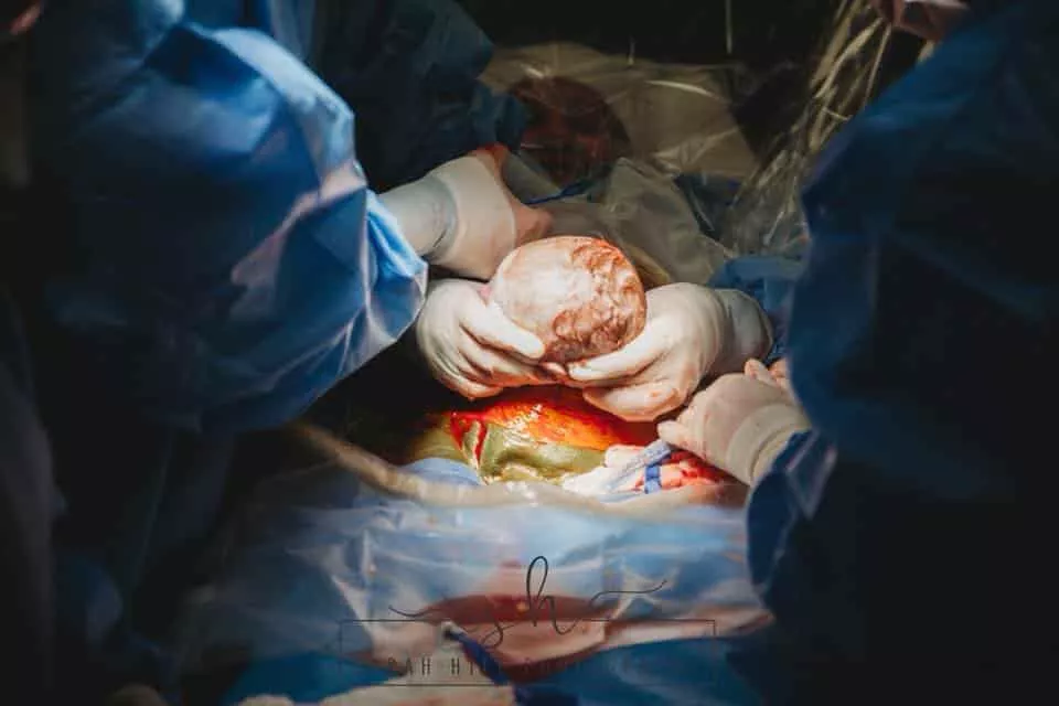 Mãe ajudou o próprio bebê a nascer durante o parto de cesárea