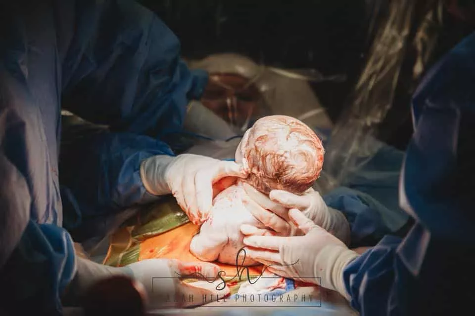 Emily ajudou o seu filho a nascer, ela puxou ele durante o parto de cesárea