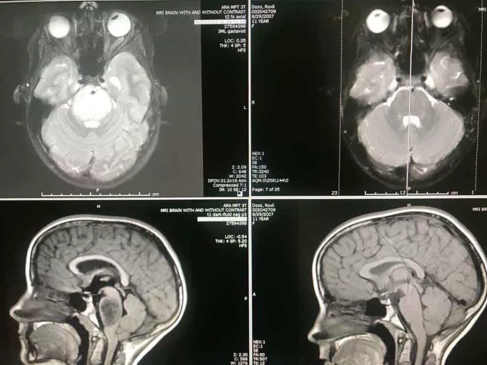 Esse é o antes e depois da ressonância magnética da menina Roxli