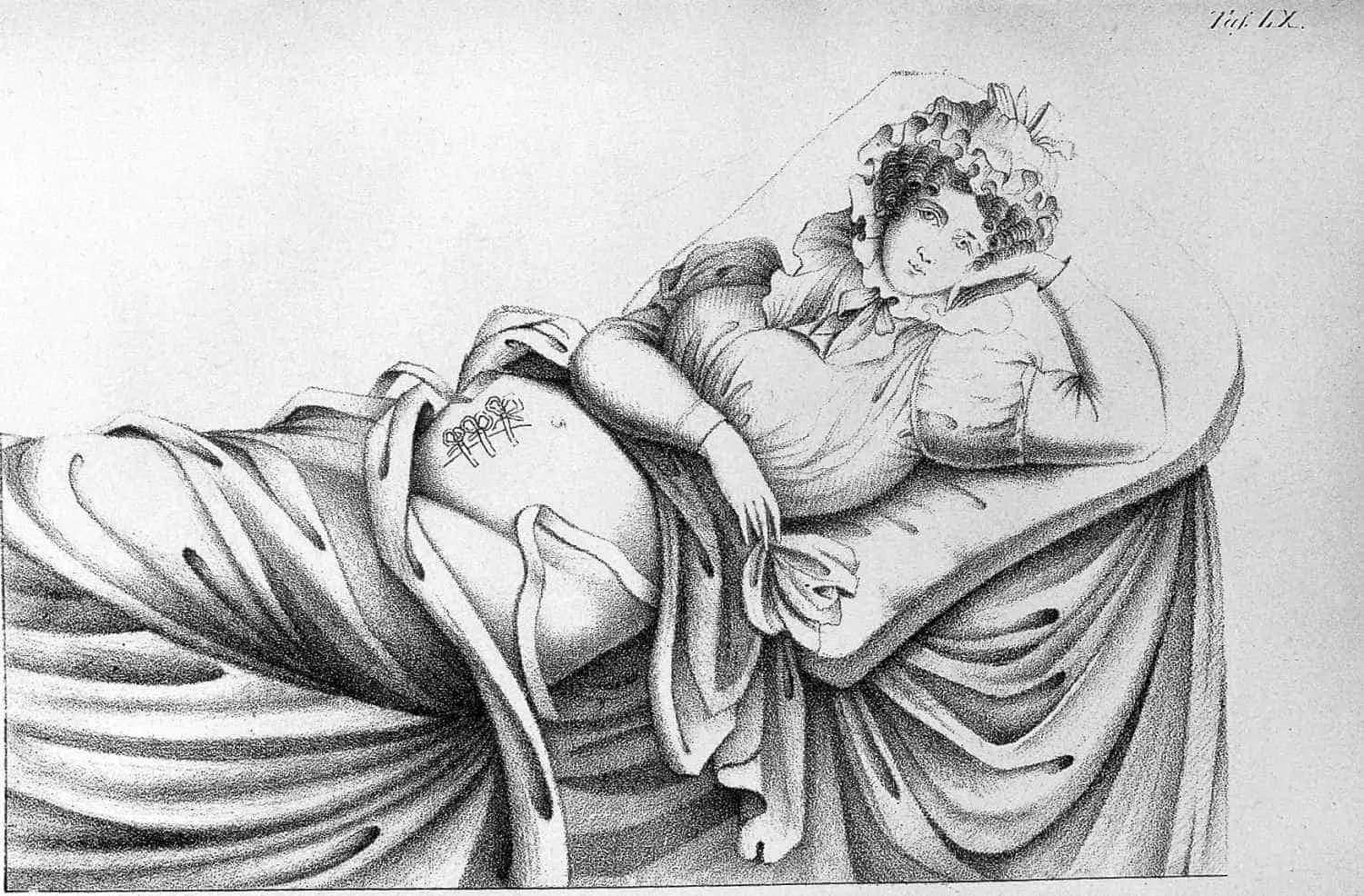 Uma mãe após cesárea, no século 19