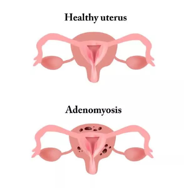 Diferença de um útero saudável de um com adenomiose uterina