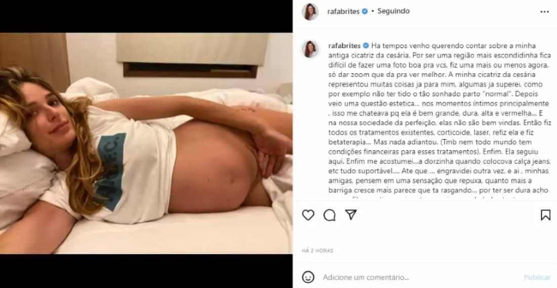 A escritora Rafa Brites, esposa de Felipe Andreoli, mostrou sua cicatriz da cesárea de seu primeiro filho 